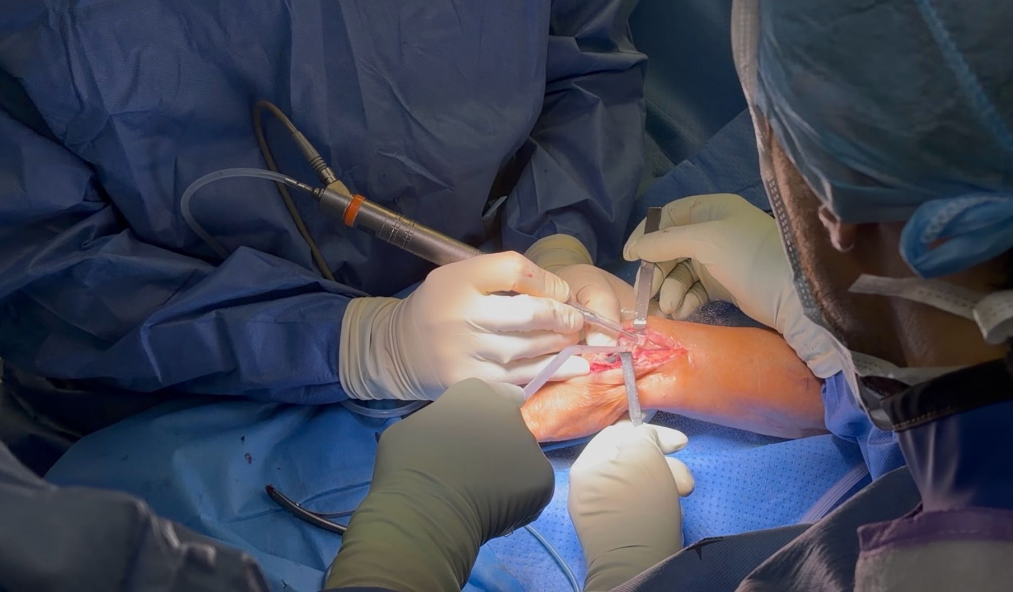 L’innovazione SMTP in chirurgia della mano: un nuovo standard di precisione